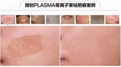 plasma离子束祛疤让疤痕看起来无痕