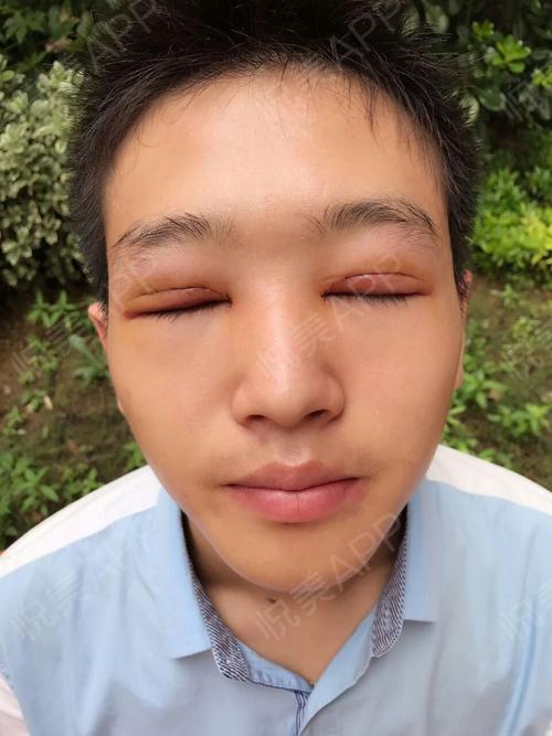 双眼皮手术第一天,作为一名男生去整形大多数人可能会