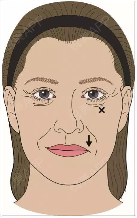 肉毒毒素眼周皱纹注射攻略