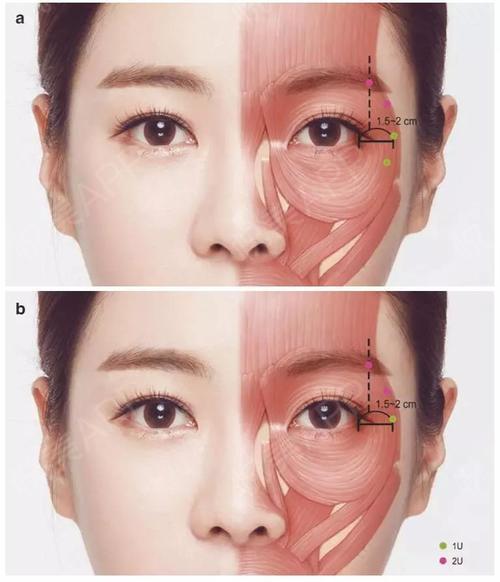 肉毒毒素眼周皱纹注射攻略