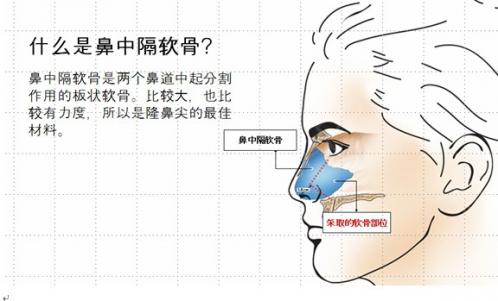 鼻中隔软骨-解决"朝天鼻"取用耳窝后部的耳软骨来隆高鼻头,创口极为