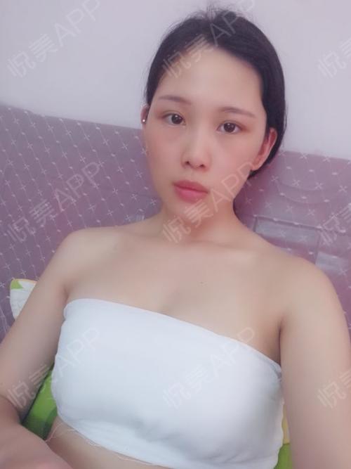 复合隆胸术后1天_自体脂肪隆胸术后1天_假体隆胸术后1天_形体填充术后