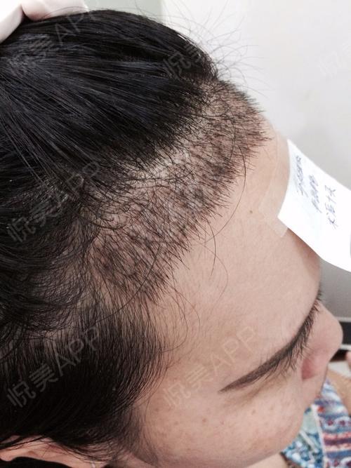 【广州肤康植发科—2000毛囊单位发际线种植—手术第10天发际线