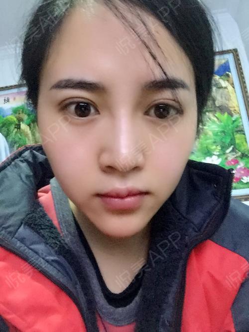 眼角术后69天_双眼皮术后69天_眼部整形术后69天_悦mer_4543658128