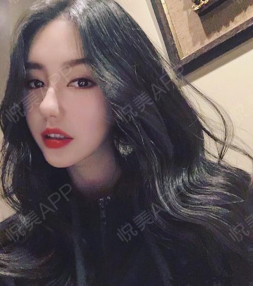 后8天_吸脂术后8天_瘦大腿术后8天_美体塑形术后8天_戴诗琪分享图片1