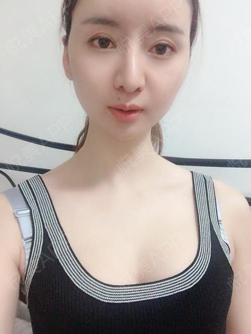 100天_自体脂肪术后100天_胸部整形术后100天_最美不过回忆分享图片8