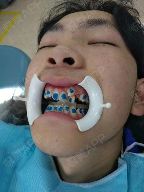 自锁托槽矫正手术当天_金属托槽矫正手术当天_牙齿矫正手术当天_牙齿