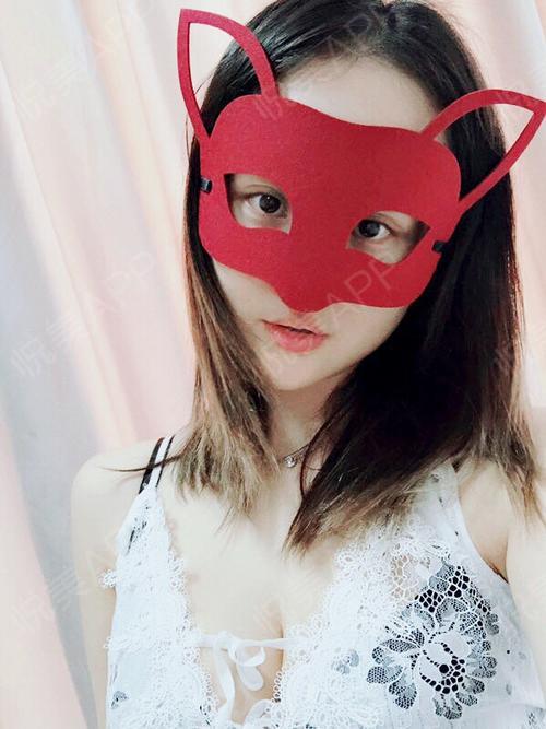 乳房下垂矫正术后30天_假体隆胸术后30天_胸型美化术后30天_乳头&乳晕