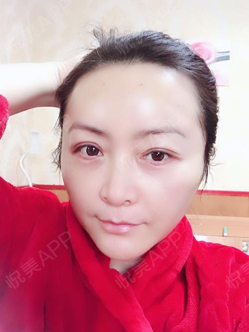 填充术后3天_注射瘦腿术后3天_自体脂肪丰眼窝术后3天_自体脂肪失败