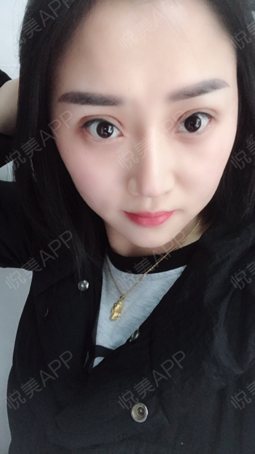 失败修复术后37天_双眼皮术后37天_眼部整形术后37天_幽兰兰分享图片1