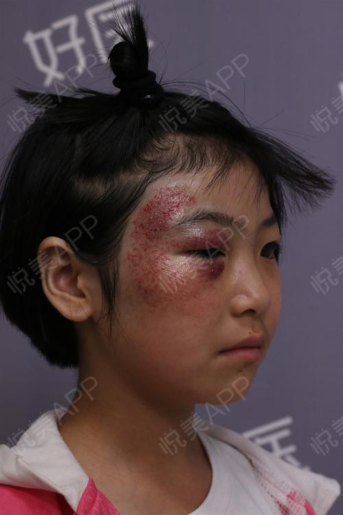 【第一次治疗】女儿脸上的太田痣,可以说是笼罩在我心.