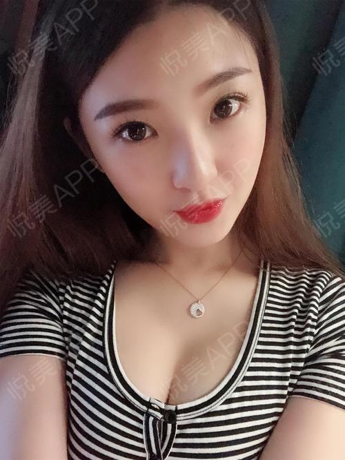 乳房下垂矫正术后183天_自体脂肪隆胸术后183天_形体填充术后183天_胸