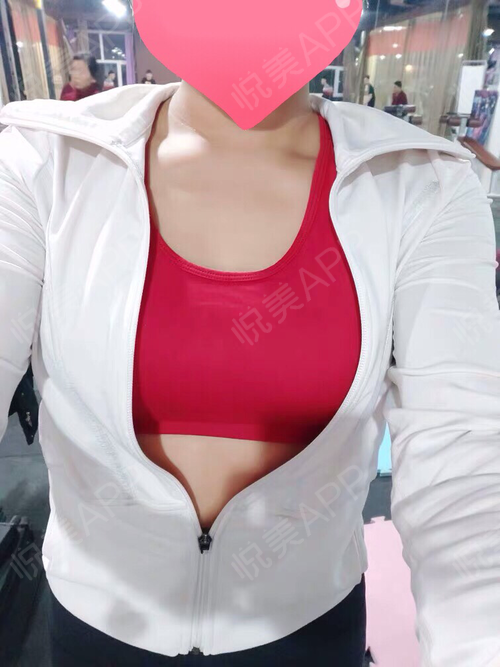 乳房下垂矫正术后543天_女性巨乳缩小术后543天_胸型美化术后543天