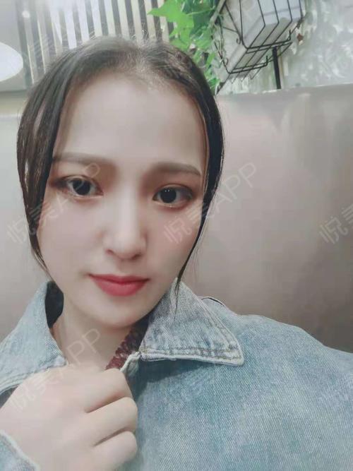 综合术后135天_开眼角术后135天_双眼皮术后135天_眼部整形术后135天