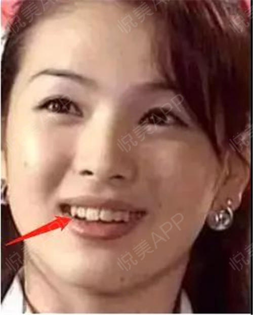 日本写真女明星5年花400万换头5次经历了电烧牙齿开头盖骨正颌手术后