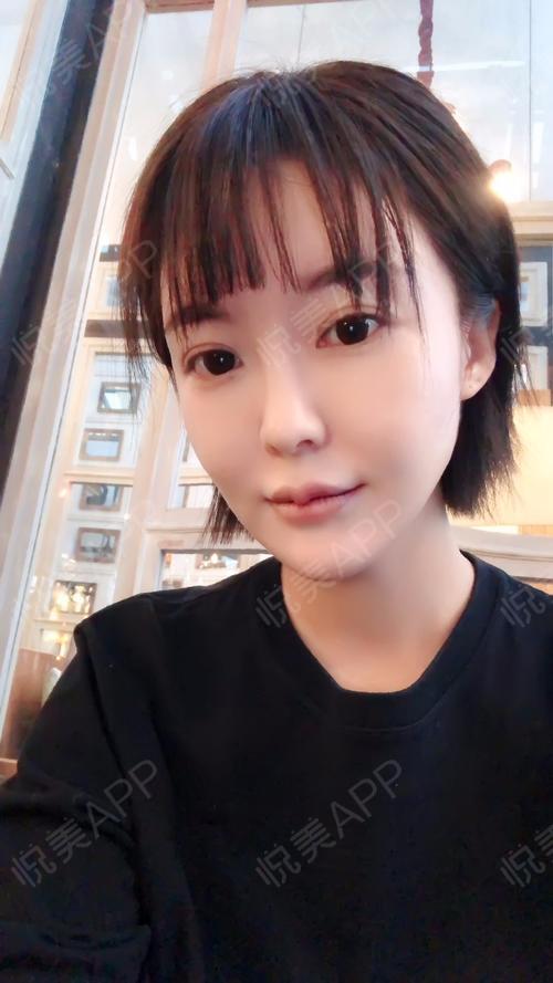 m唇手术术后10天_唇型美化术后10天_口唇整形术后10天_悦mer