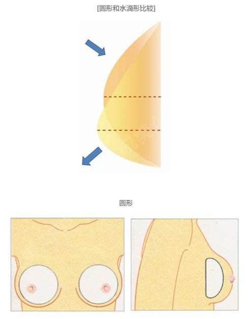 复合隆胸_胸部假体取出_乳房下垂矫正_自体脂肪隆胸_假体隆胸_其他