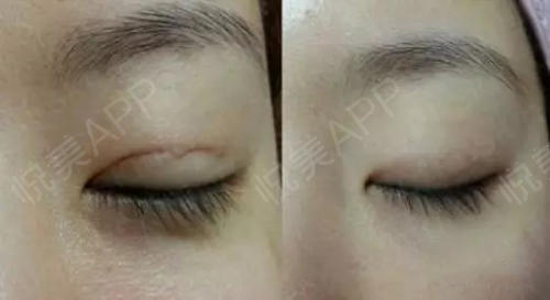 双眼皮的疤痕增生该怎么处理?怎样避免留疤