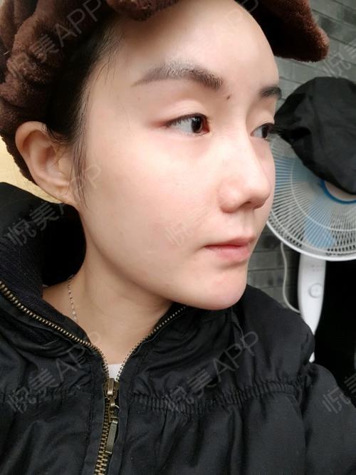 玻尿酸丰鼻基底术后46天_玻尿酸面部填充术后46天_填充塑形术后46天