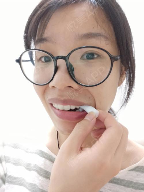 牙套更好滴和牙齿磨合,经常锻炼咬合,也不容易出现"牙膏脸"哦(-ω-`)