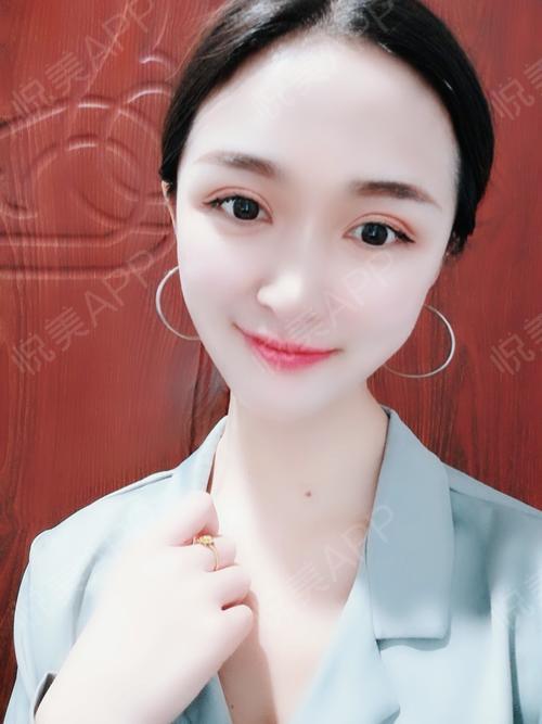 眼综合整形术后30天_眼型矫正术后30天_眼综合术后30天_开眼角术后30