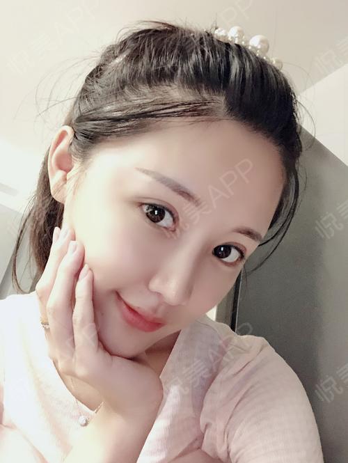 开外眼角术后60天_开内眼角术后60天_全切双眼皮术后60天_开眼角术后