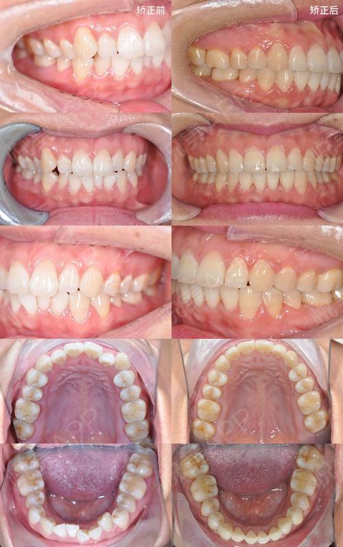 主要问题是牙齿排列不齐,门牙前突,脸型不对称.