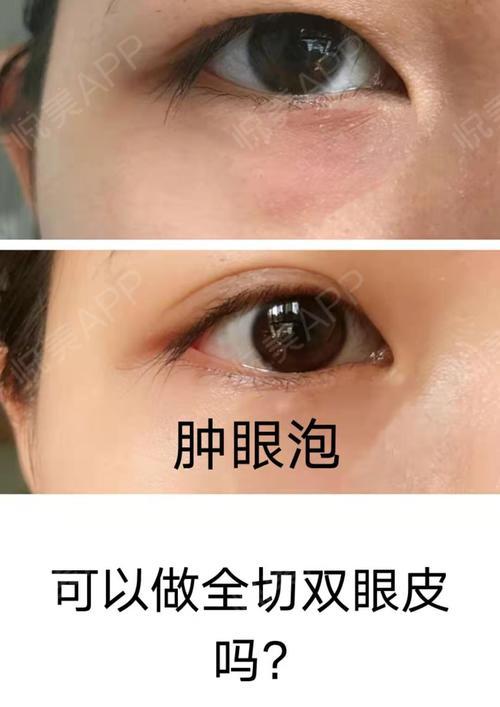 肿泡眼就不能割双眼皮了肿眼泡割双眼皮该怎么选