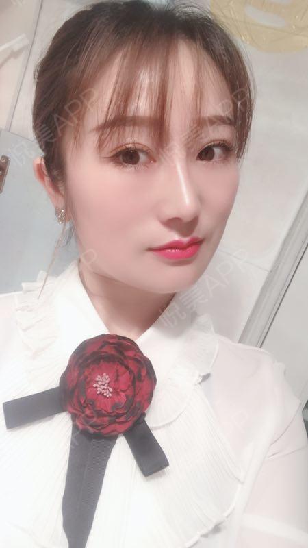 鼻综合整形术后30天_垫鼻尖术后30天_垫鼻基底术后30天_鼻型矫正术后