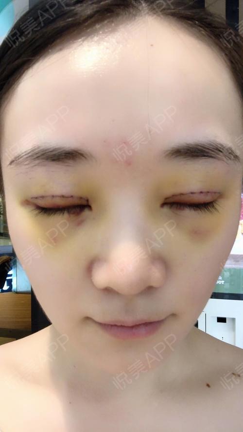 【切开双眼皮术后第3天】近期在美莱做了双眼皮手术,.