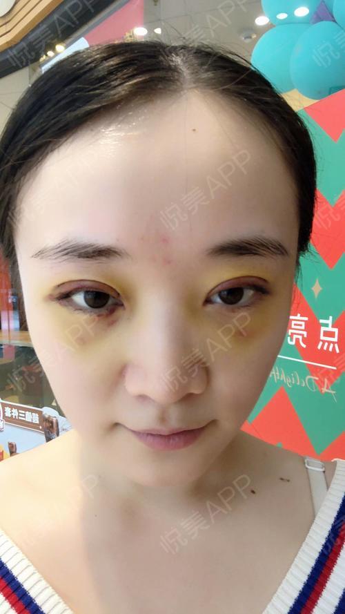 【切开双眼皮术后第3天】近期在美莱做了双眼皮手术,.