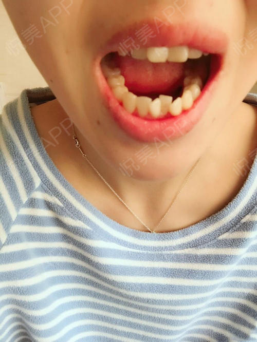 我的牙齿从照片上看很清楚,上牙门牙外翻,下牙拥挤.牙齿矫正_悦美整形