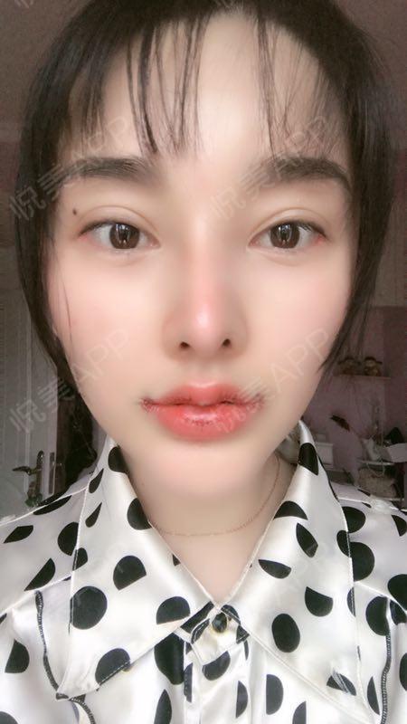 m唇手术术后3天_唇型美化术后3天_口唇整形术后3天_丹妮是小仙女呀