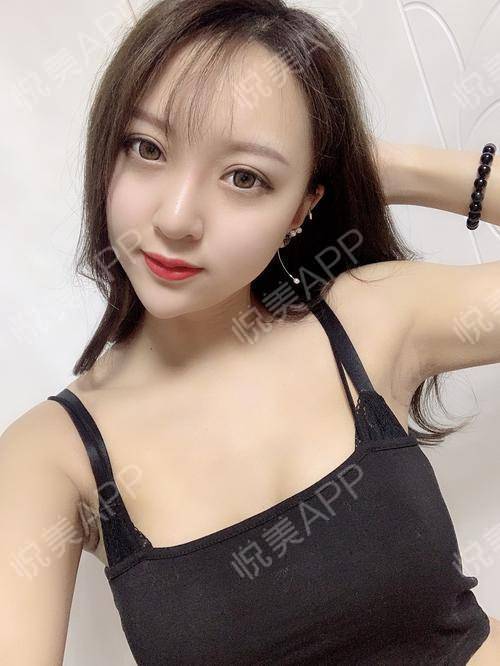 假体隆胸术后19天_隆胸术后19天_胸部整形术后19天_悦mer_5772431768