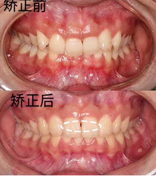 牙齿矫正的新锅牙齿黑三角