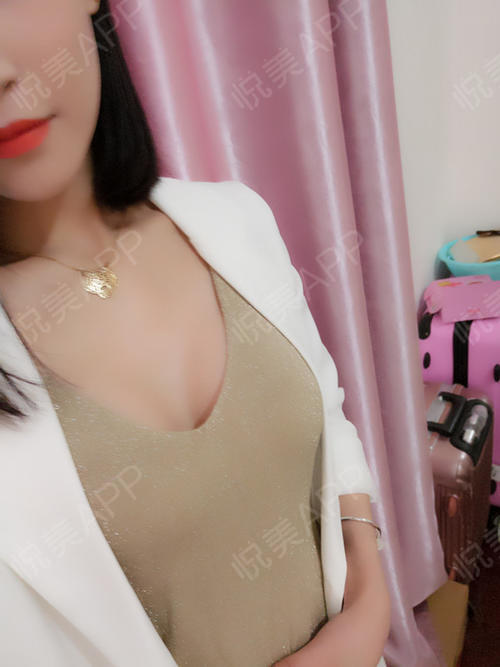 复合隆胸术后32天_乳房下垂矫正术后32天_吸脂去副乳术后32天_自体