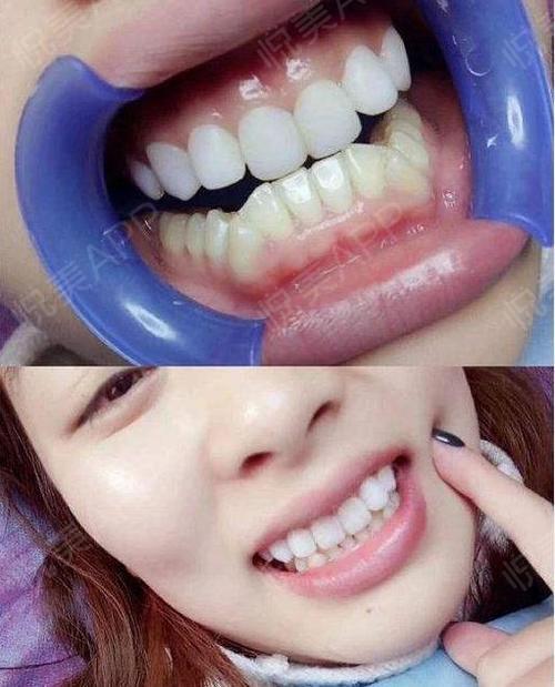 牙齿贴面能修复哪些问题?