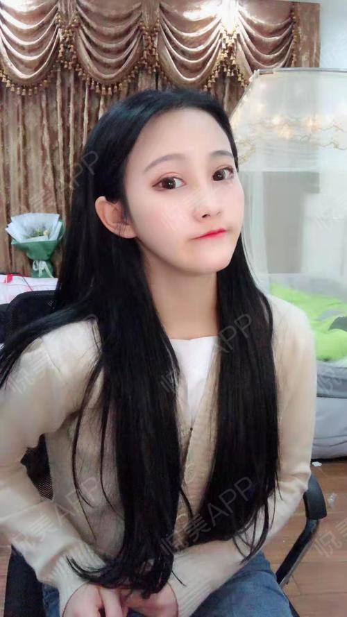 眼角术后19天_双眼皮术后19天_眼部整形术后19天_小老婆桂哥分享图片5