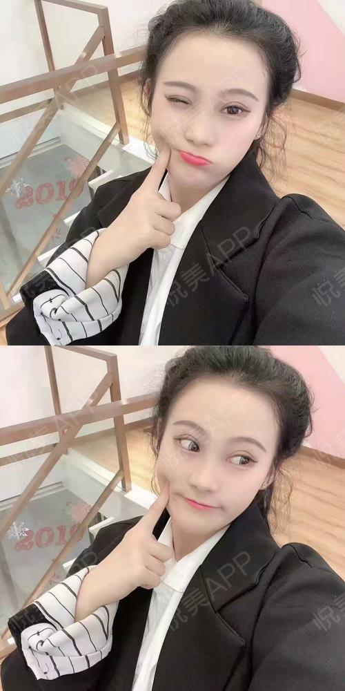 眼角术后19天_双眼皮术后19天_眼部整形术后19天_小老婆桂哥分享图片6