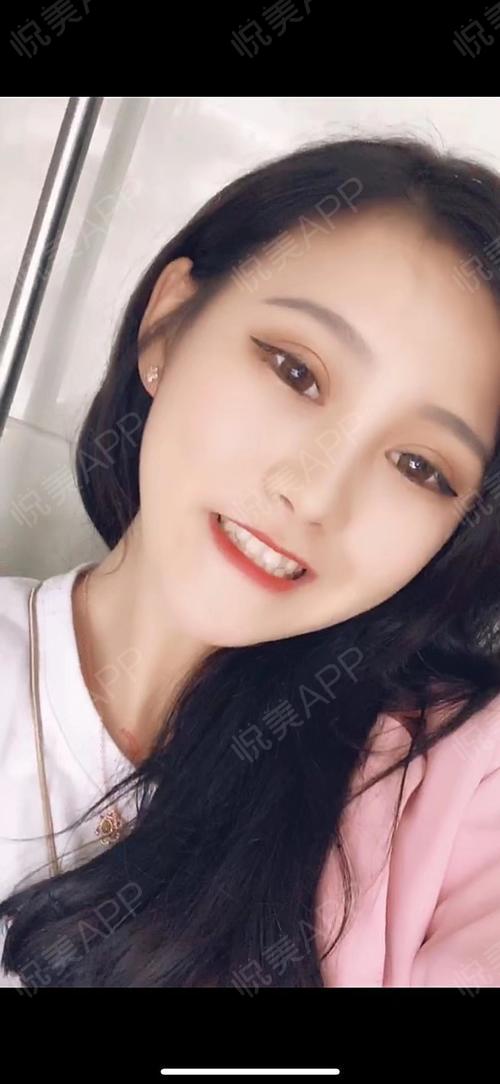 眼角术后63天_双眼皮术后63天_眼部整形术后63天_小老婆桂哥分享图片3