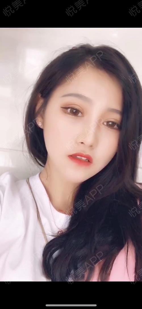 眼角术后63天_双眼皮术后63天_眼部整形术后63天_小老婆桂哥分享图片4