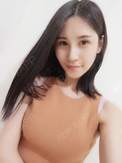 复合隆胸术后57天_乳房下垂矫正术后57天_吸脂去副乳术后57天_自体