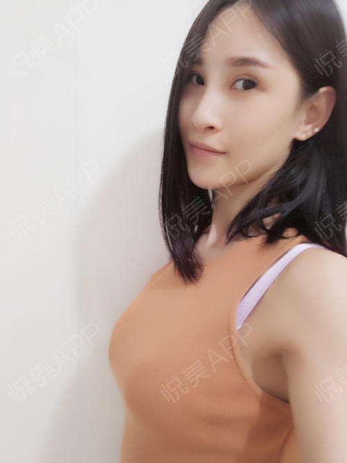 复合隆胸术后57天_乳房下垂矫正术后57天_吸脂去副乳术后57天_自体