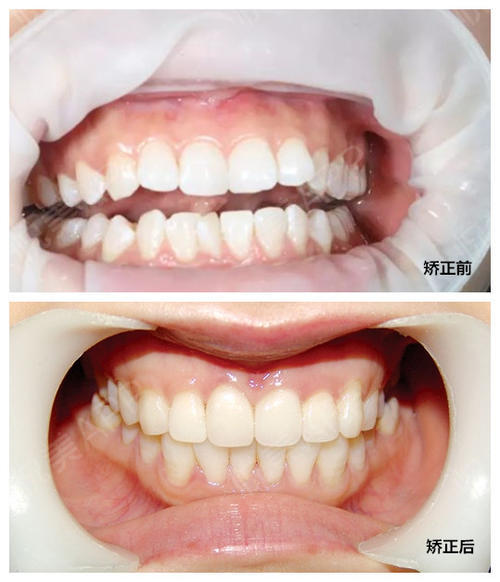 牙齿矫正中片切的作用和优势体现在什么地方?