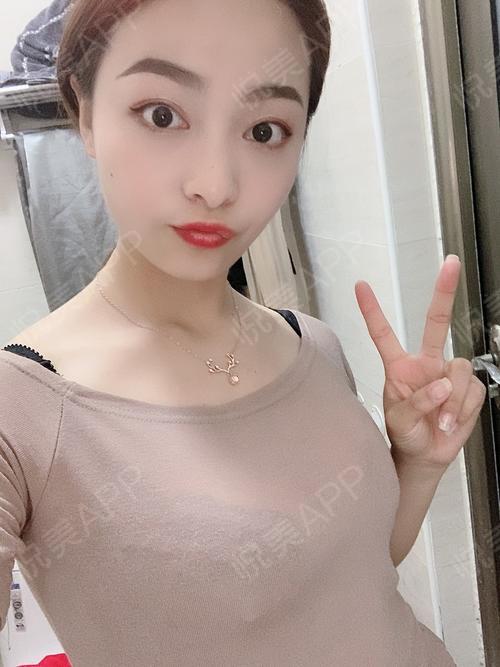 假体隆胸术后229天_隆胸术后229天_胸部整形术后229天_tina_荼蘼分享