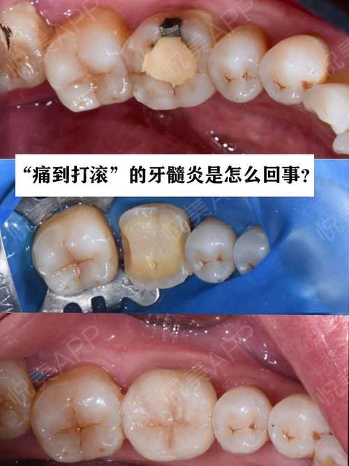 牙髓炎是怎么回事?