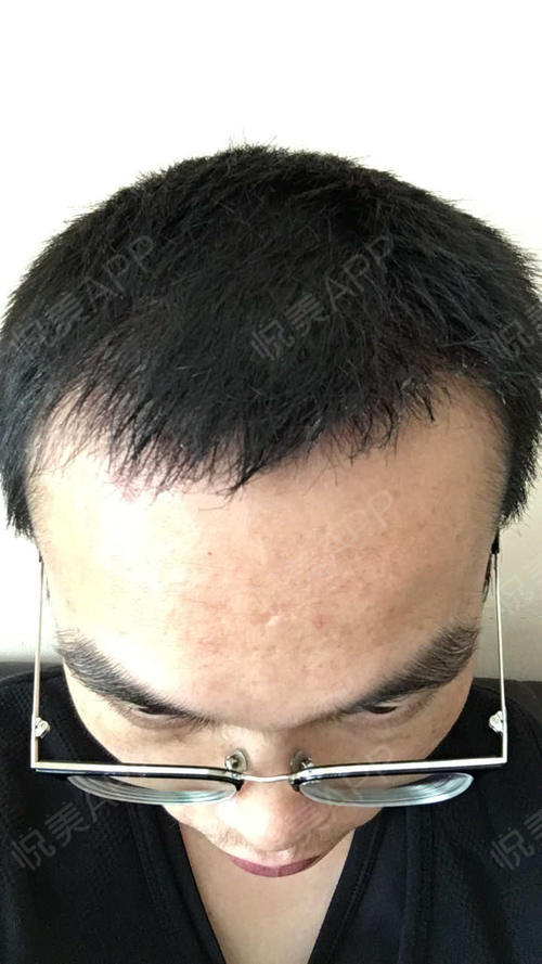 发际线种植后第二个月,效果正常,现在头发密度很高了,长大很茂盛了