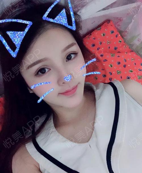 下睑下至术后122天_眼型矫正术后122天_眼部整形术后122天_悦mer