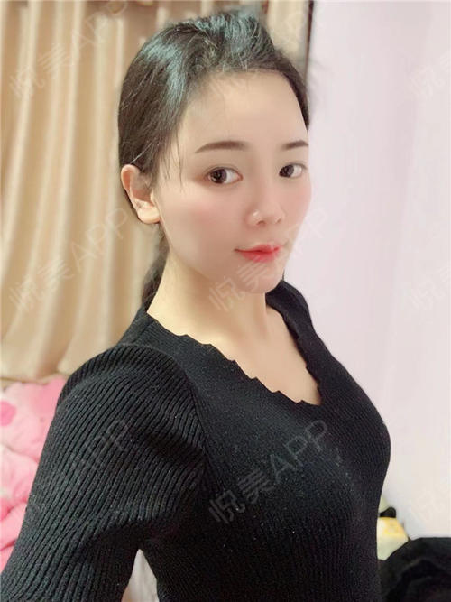 假体隆胸术后106天_隆胸术后106天_胸部整形术后106天_悦mer