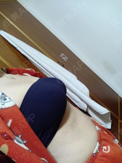 乳房下垂矫正术后366天_女性巨乳缩小术后366天_乳头缩小术后366天_胸